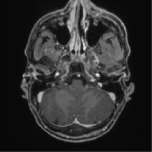 Anaplastic oligodendroglioma with skull fracture (Radiopaedia 74831-85845 Axial T1 C+ fat sat 8).png