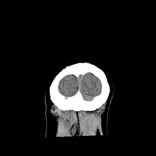 Aneursym related subarachnoid hemorrhage with hydrocephalus (Radiopaedia 45105-49083 Coronal non-contrast 64).jpg