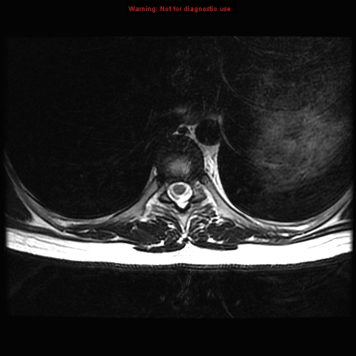 File:Aneurysmal bone cyst (Radiopaedia 9419-10103 Axial T2 6).jpg