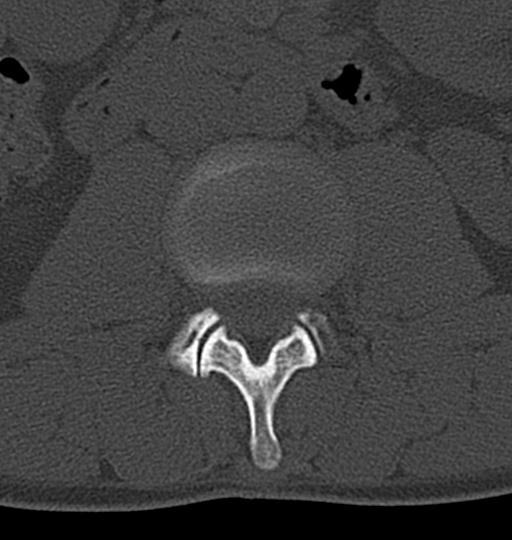 Aneurysmal bone cyst T11 (Radiopaedia 29294-29721 Axial bone window 83).jpg