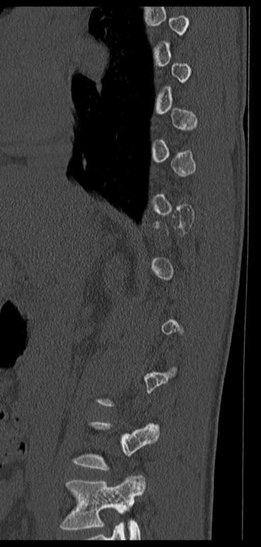 Aneurysmal bone cyst T11 (Radiopaedia 29294-29721 Sagittal bone window 55).jpg