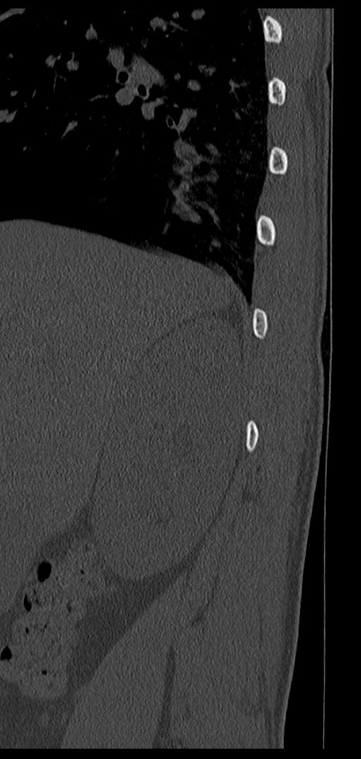 Aneurysmal bone cyst T11 (Radiopaedia 29294-29721 Sagittal bone window 80).jpg