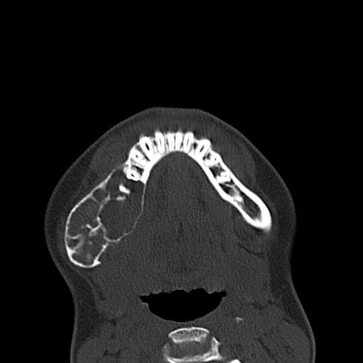 Aneurysmal bone cyst of the mandible (Radiopaedia 43280-46601 Axial bone window 17).jpg