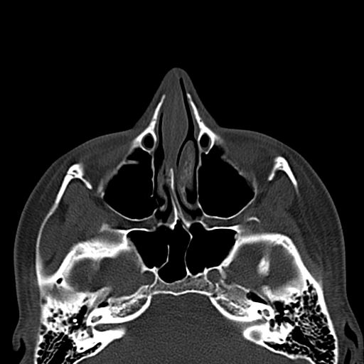 File:Aneurysmal bone cyst of the mandible (Radiopaedia 43280-46601 Axial bone window 83).jpg