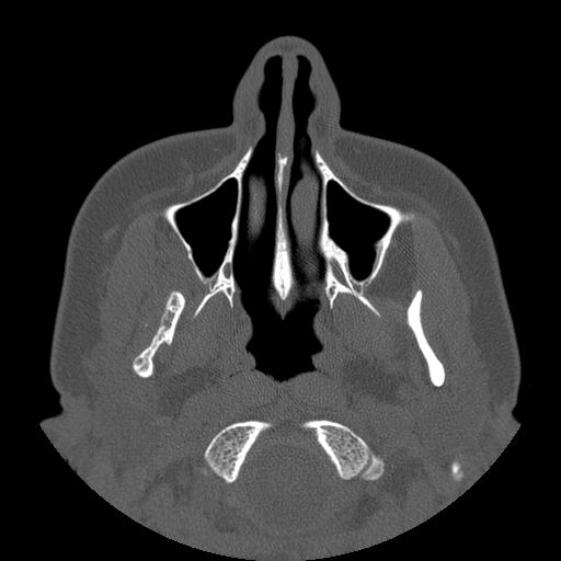 File:Aneurysmal bone cyst of the mandible (Radiopaedia 43280-46823 Axial bone window 109).jpg