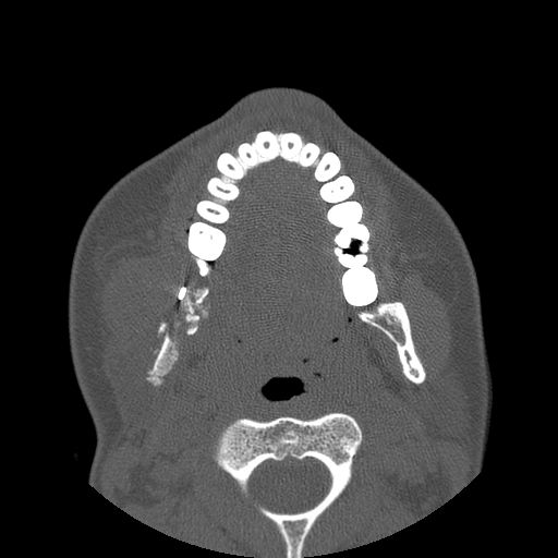 Aneurysmal bone cyst of the mandible (Radiopaedia 43280-46823 Axial bone window 70).jpg