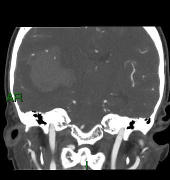 Aneurysmal subarachnoid hemorrhage with intra-axial extension (Radiopaedia 84371-99732 C 49).jpg