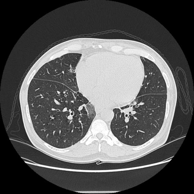 Angioinvasive aspergellosis (Radiopaedia 66995-76315 Axial lung window 34).jpg
