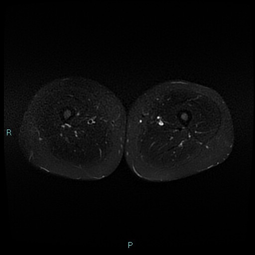 Angioleiomyoma (Radiopaedia 85442-101078 Axial STIR 51).jpg