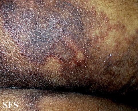 Angioma-Sudoriparous Angioma (Dermatology Atlas 3).jpg