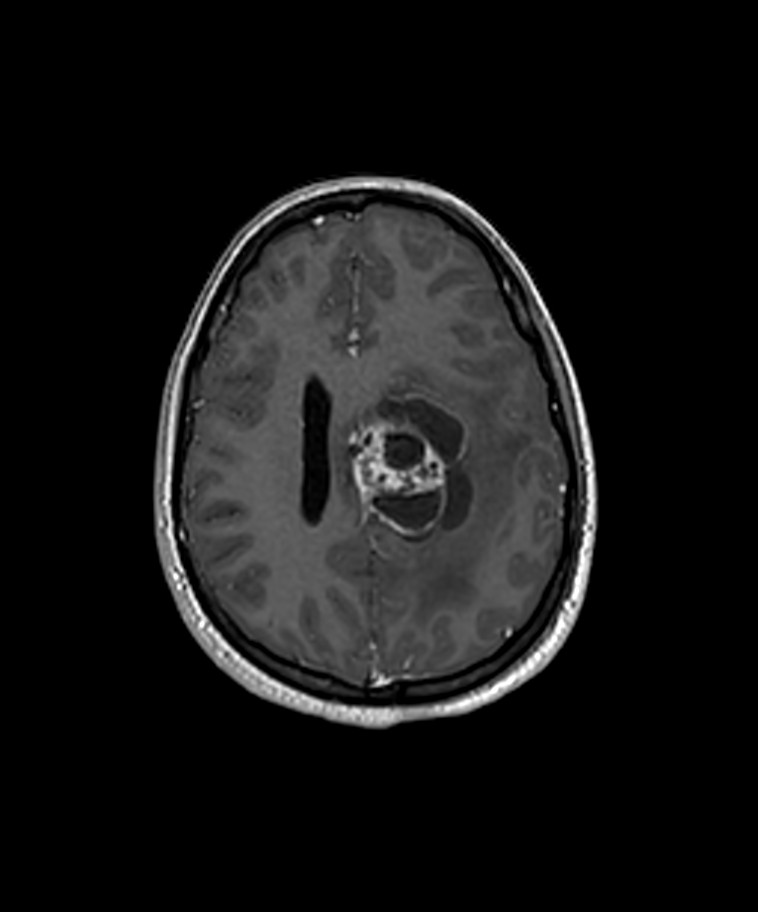 Angiomatous meningioma (Radiopaedia 79459-92577 Axial T1 C+ 3D ISO 25).jpg