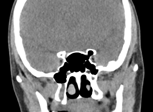 Angular dermoid cyst (Radiopaedia 88967-105790 Coronal non-contrast 49).jpg
