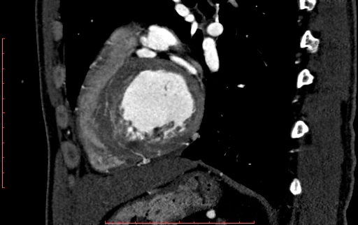 Anomalous left coronary artery from the pulmonary artery (ALCAPA) (Radiopaedia 70148-80181 C 171).jpg