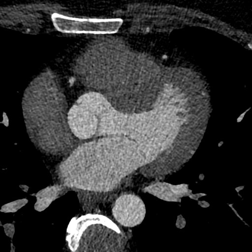 File:Anomalous origin of the left coronary artery with malignant course (Radiopaedia 77842-90126 C 119).jpeg
