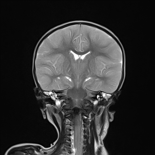 File:Anoxic brain injury (Radiopaedia 79165-92139 Coronal T2 15).jpg