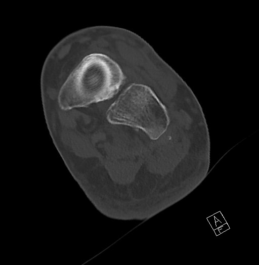 Anterior calcaneal process fracture (Radiopaedia 63353-71943 Axial bone window 88).jpg