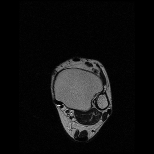 File:Anterior calcaneal process fracture (Radiopaedia 74654-85611 Axial T2 1).jpg