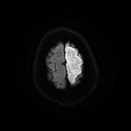 Anterior cerebral artery infarction (Radiopaedia 46794-51323 Axial DWI 26).jpg
