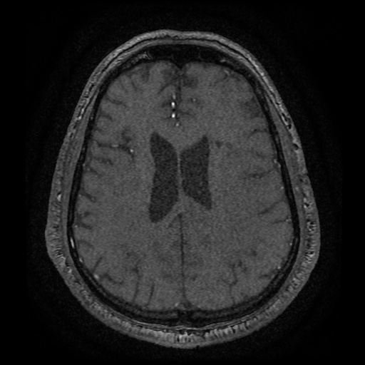 Anterior cerebral artery infarction (Radiopaedia 46794-51323 Axial MRA 153).jpg