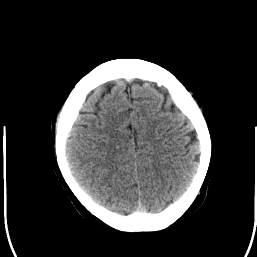 File:Anterior cerebral artery territory infarct (Radiopaedia 39327-41581 Axial non-contrast 23).png