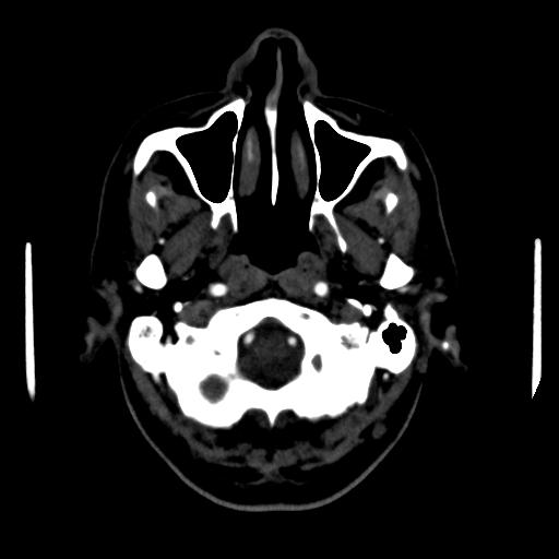 File:Anterior communicating artery aneurysm (Radiopaedia 16633-16335 A 2).jpg