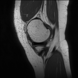 Anterior cruciate ligament rupture and posteromedial corner injury (Radiopaedia 67338-76723 Sagittal PD 35).jpg