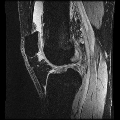 Anterior cruciate ligament tear (Radiopaedia 61500-69462 F 49).jpg