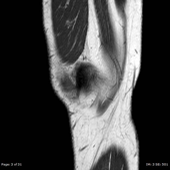 File:Anterior cruciate ligament tear (Radiopaedia 70783-80964 Sagittal T1 3).jpg