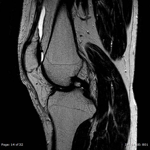 File:Anterior cruciate ligament tear (Radiopaedia 70783-80964 Sagittal T2 14).jpg
