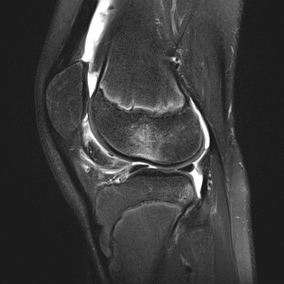 File:Anterior cruciate ligament tear - pediatric (Radiopaedia 62152-70260 Sagittal PD fat sat 25).jpg
