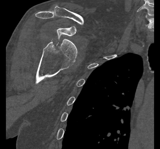 Anterior glenohumeral dislocation with Hill-Sachs lesion (Radiopaedia 62877-71249 Coronal bone window 36).jpg
