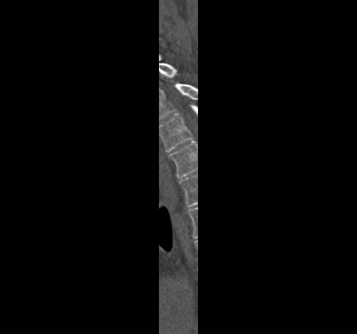 Anterior glenohumeral dislocation with Hill-Sachs lesion (Radiopaedia 62877-71249 Sagittal bone window 86).jpg