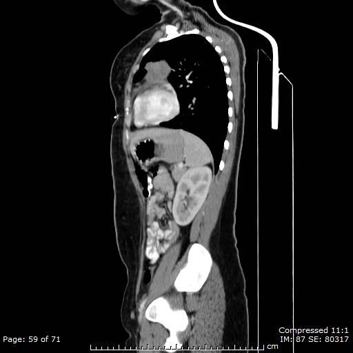 File:Anterior mediastinal B cell Lymphoma (Radiopaedia 50677-56114 C 30).jpg