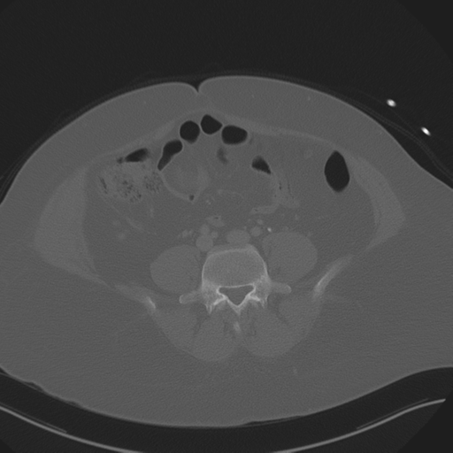 Anterior superior iliac spine avulsion fracture (Radiopaedia 44541-48244 Axial bone window 66).png