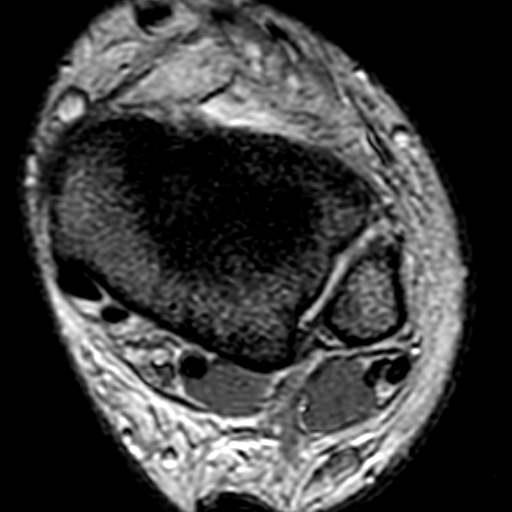 File:Anterior talofibular ligament rupture (Radiopaedia 15831-15484 Axial T2* 5).jpg