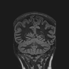 Anterior temporal encephalocele (Radiopaedia 82624-96808 Coronal FLAIR 38).jpg
