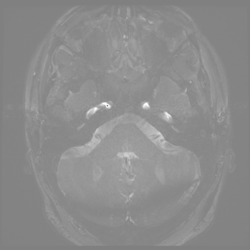 Anterior temporal lobe perivascular space (Radiopaedia 68481-78041 E 2).png