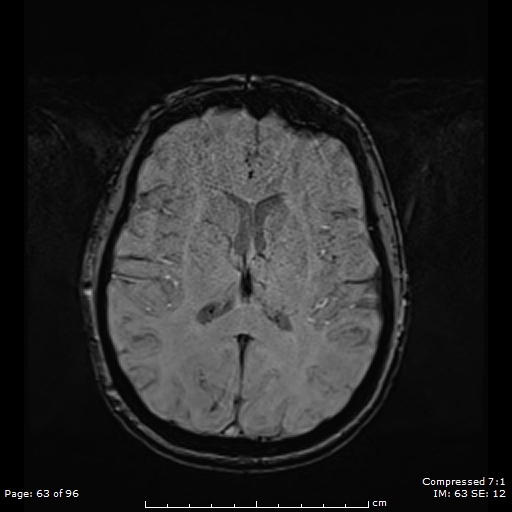 Anterior temporal lobe perivascular space (Radiopaedia 88283-104914 Axial SWI 32).jpg