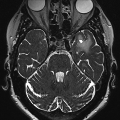 Anterior temporal pole cysts (Radiopaedia 46629-51102 Axial 25).png
