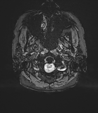 Anterior temporal pole cysts (Radiopaedia 46629-51102 Axial SWI 2).png