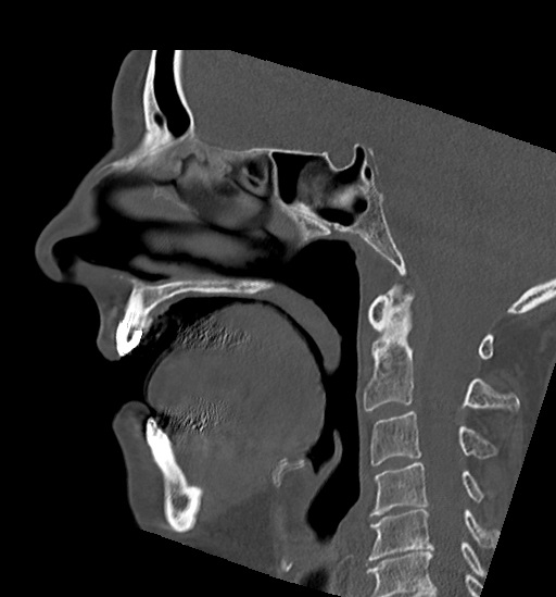 Anterior temporomandibular joint dislocation (Radiopaedia 59430-66784 B 33).jpg
