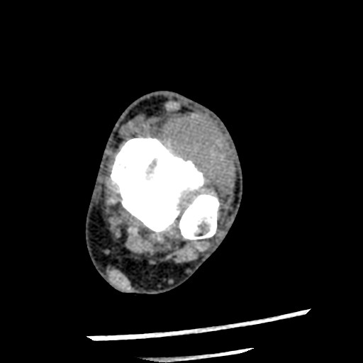 Anterior tibial artery false aneurysm (Radiopaedia 88984-105809 A 112).jpg