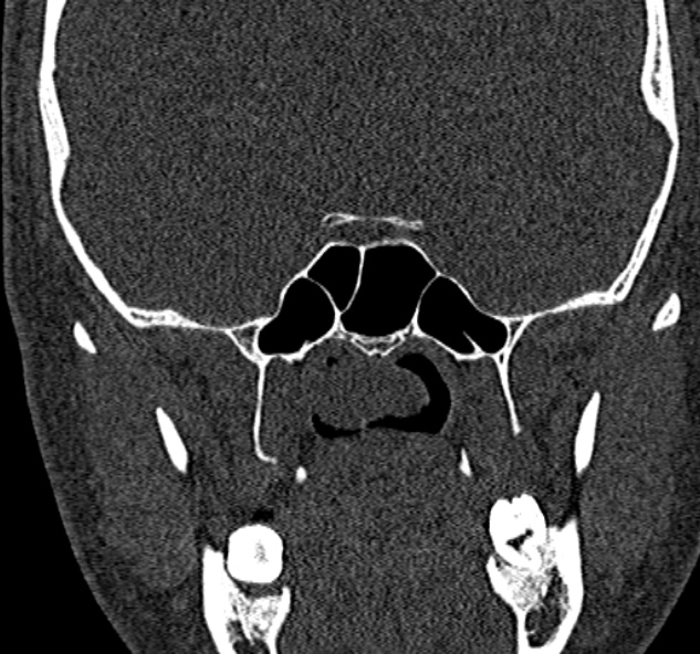Antrochoanal polyp (Radiopaedia 30002-30554 Coronal bone window 65).jpg
