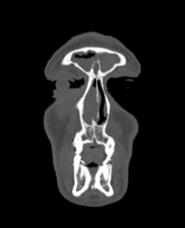 Antrochoanal polyp (Radiopaedia 79011-92169 Coronal bone window 78).jpg