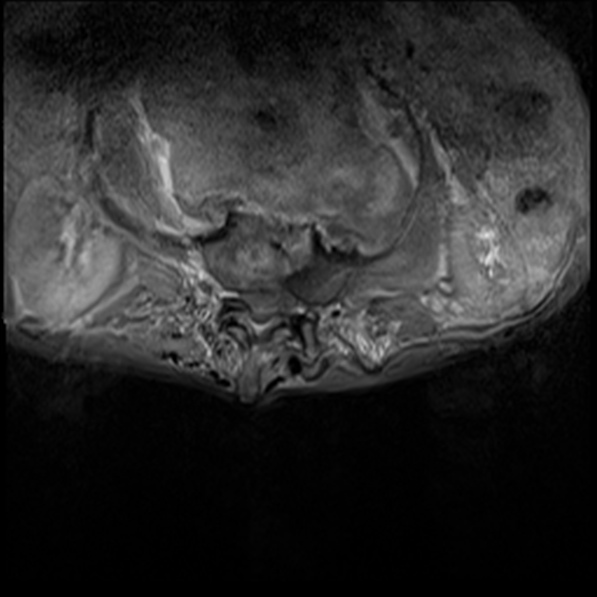 File:Aortic aneurysm with spinal destruction (Radiopaedia 42301-45409 Axial T1 fat sat 12).jpg