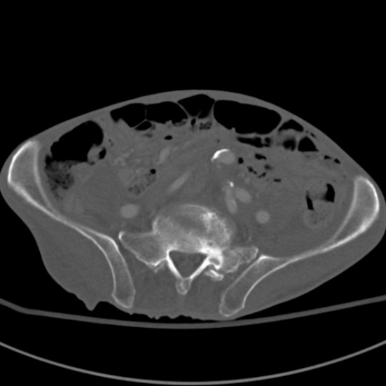 Aortic aneurysm with spinal destruction (Radiopaedia 42301-45410 Axial bone window 76).jpg