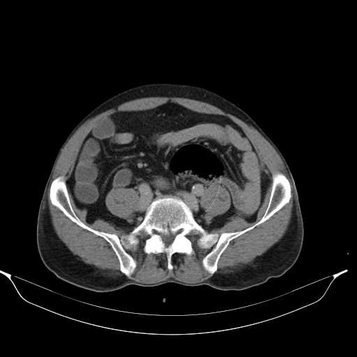 File:Aortic dissection- Stanford type A (Radiopaedia 22085-22085 Axial C+ delayed 37).jpg