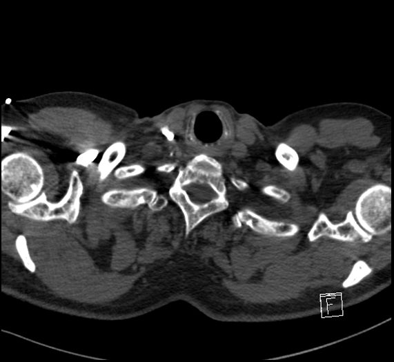 File:Aortic dissection (CTPA) (Radiopaedia 75506-86751 Axial C+ CTPA 5).jpg