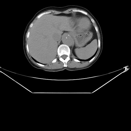 File:Aortic dissection (Radiopaedia 25350-25604 B 39).jpg