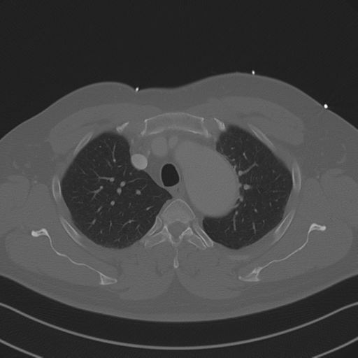 File:Aortic dissection (Radiopaedia 50763-56234 Axial bone window 31).png